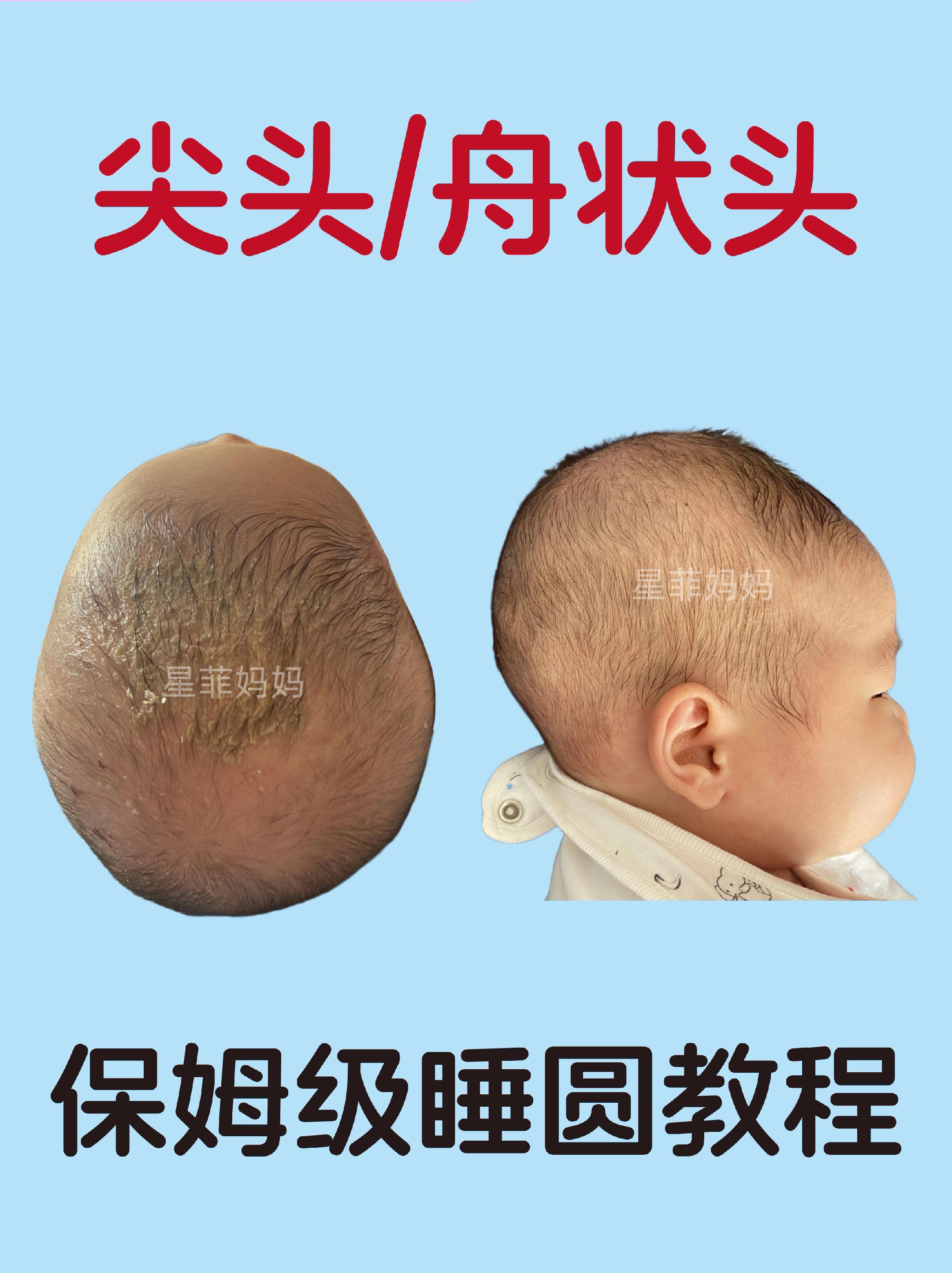 尖头|长头如何睡圆头。