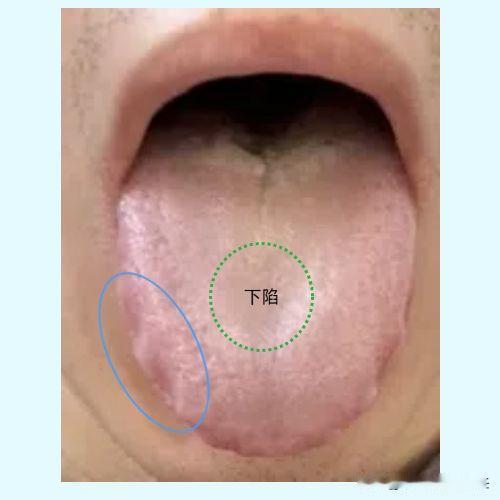 浑身没劲，腿根湿的不行，中医教你一招解决！

大家好啊，今天我们继续分析粉丝舌象