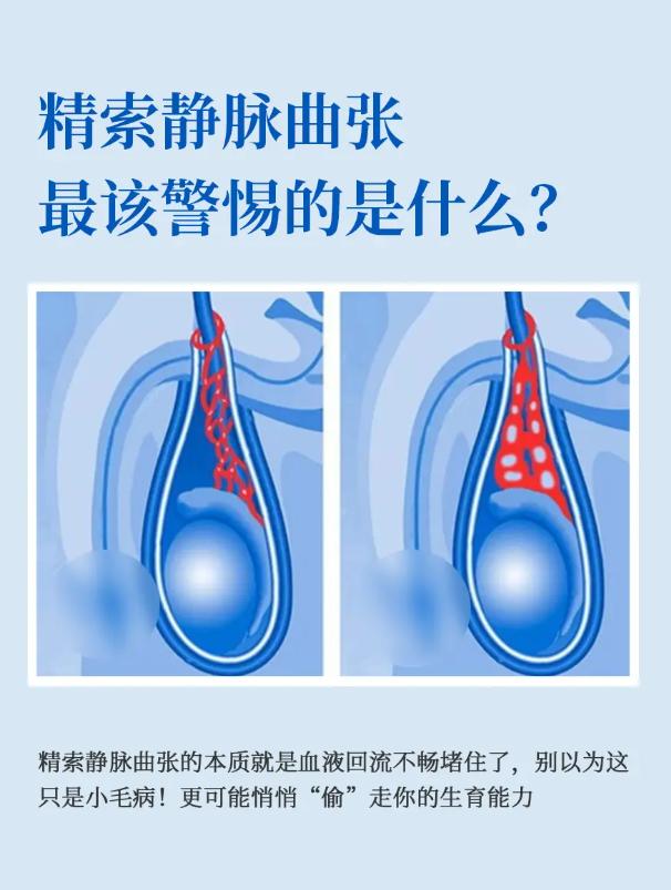精索静脉曲张，最该警惕的是什么？