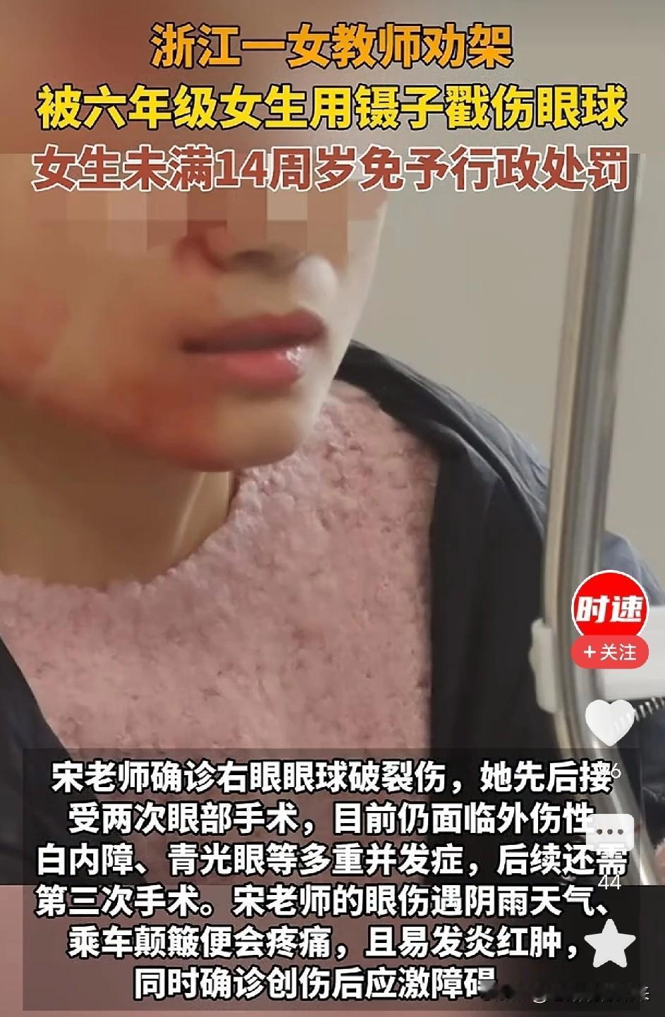 拉架拉到被六年级女生用镊子刺穿右眼，小学女教师做错了什么，要付出如此代价？

浙