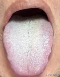 一看舌苔又白又腻，就用附子理中丸？为啥会没效果，这样调效果翻倍
 病人主诉：乏力