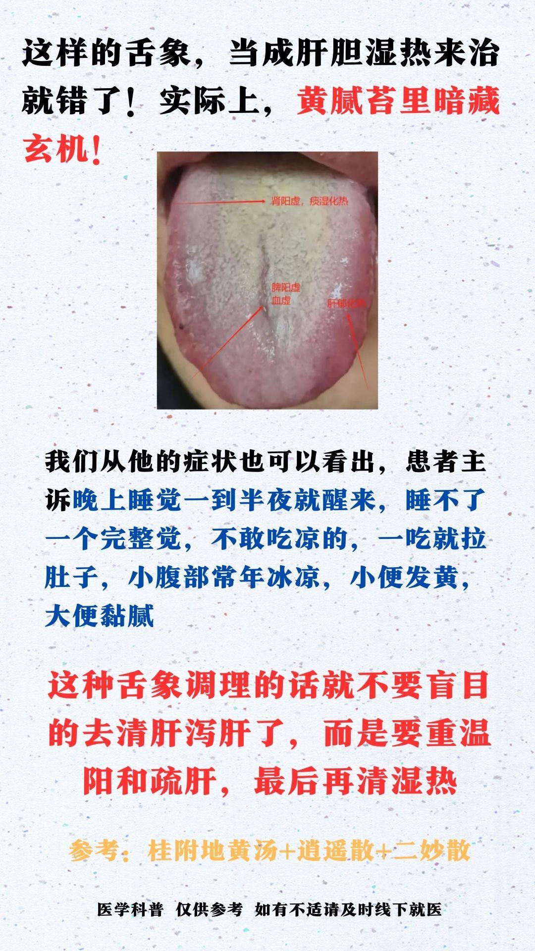 这样的舌象，当成肝胆湿热来治就错了！实际上，黄腻苔里暗藏玄机！#舌诊#