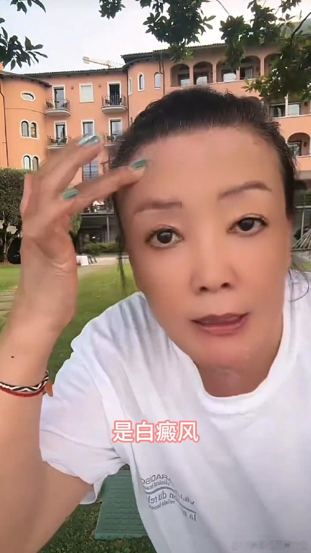 #张兰说白癜风控制住了# 张兰说白癜风控制器住了，目前正在意大利治疗 ​​​