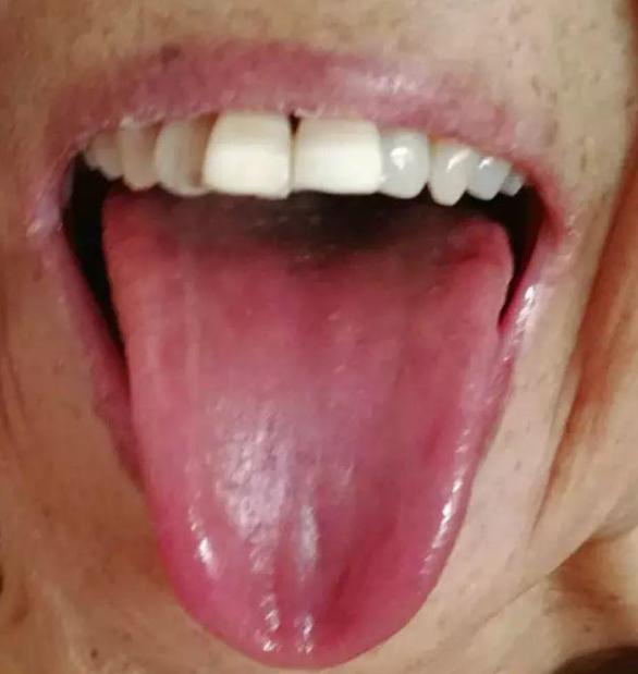 舌红需滋阴，舌白要补阳，舌黄腻要清热，记住这3点，调理不走弯路[给力][给力][