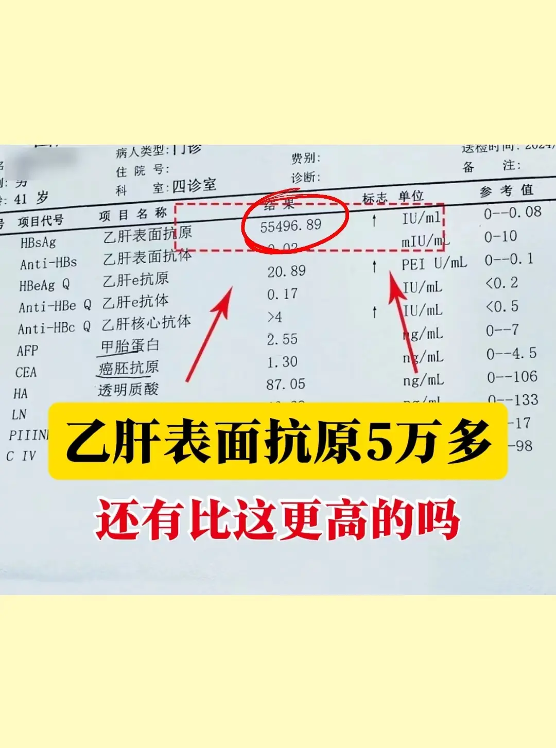 这是前几天专家门诊上一位泰安患者的检查单，目前表面抗原已经到了5万多。...