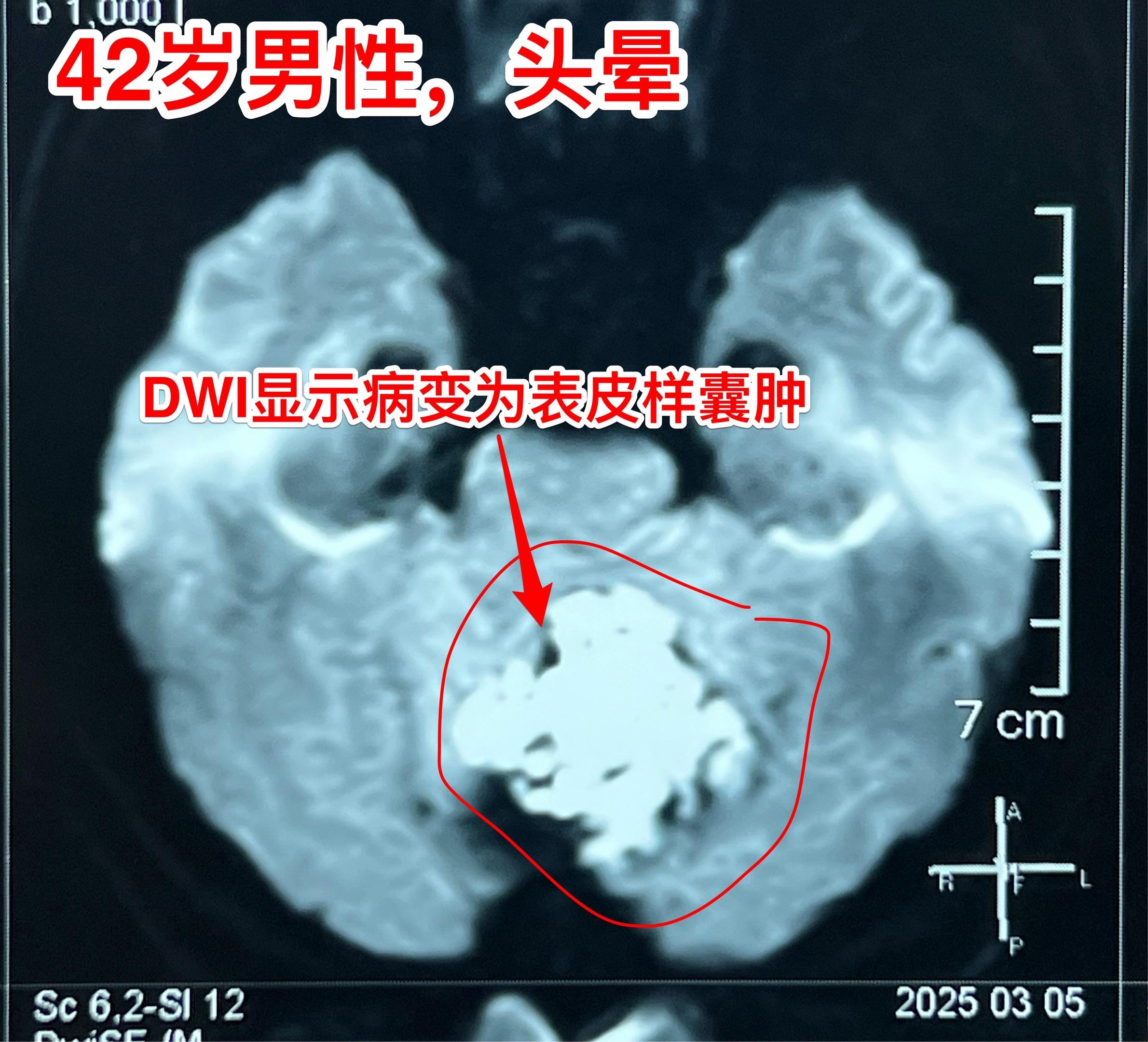 表皮样囊肿（胆脂瘤）并不是真正的肿瘤。这是先天性胚胎发育异常造成的疾病...