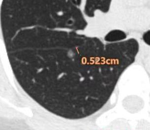 肺磨玻璃结节，要不要做PET-CT和增强CT？基本上每次门诊都有朋友问我。上周门