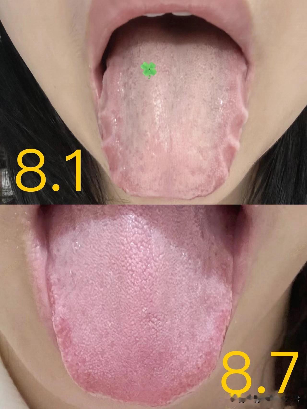 仅7天，舌边齿痕消失了，可别再说湿难除了！

患者初诊时主诉：浑身疲惫，像被一块