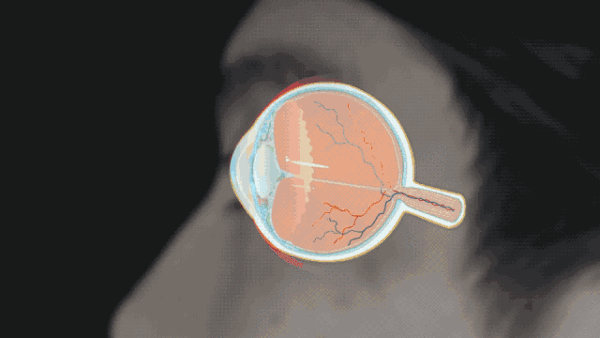 原来眼镜有寿命【怎么判断假性近视还是真性近视】常说的“假性近视”在医学上被称为调