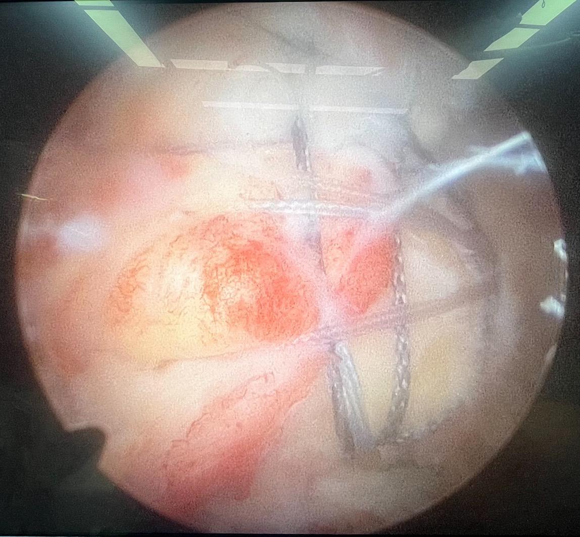 巨大肩袖撕裂修复。每一次置钉过线，每一次钳抓，每一次调整，都凝聚了我们...