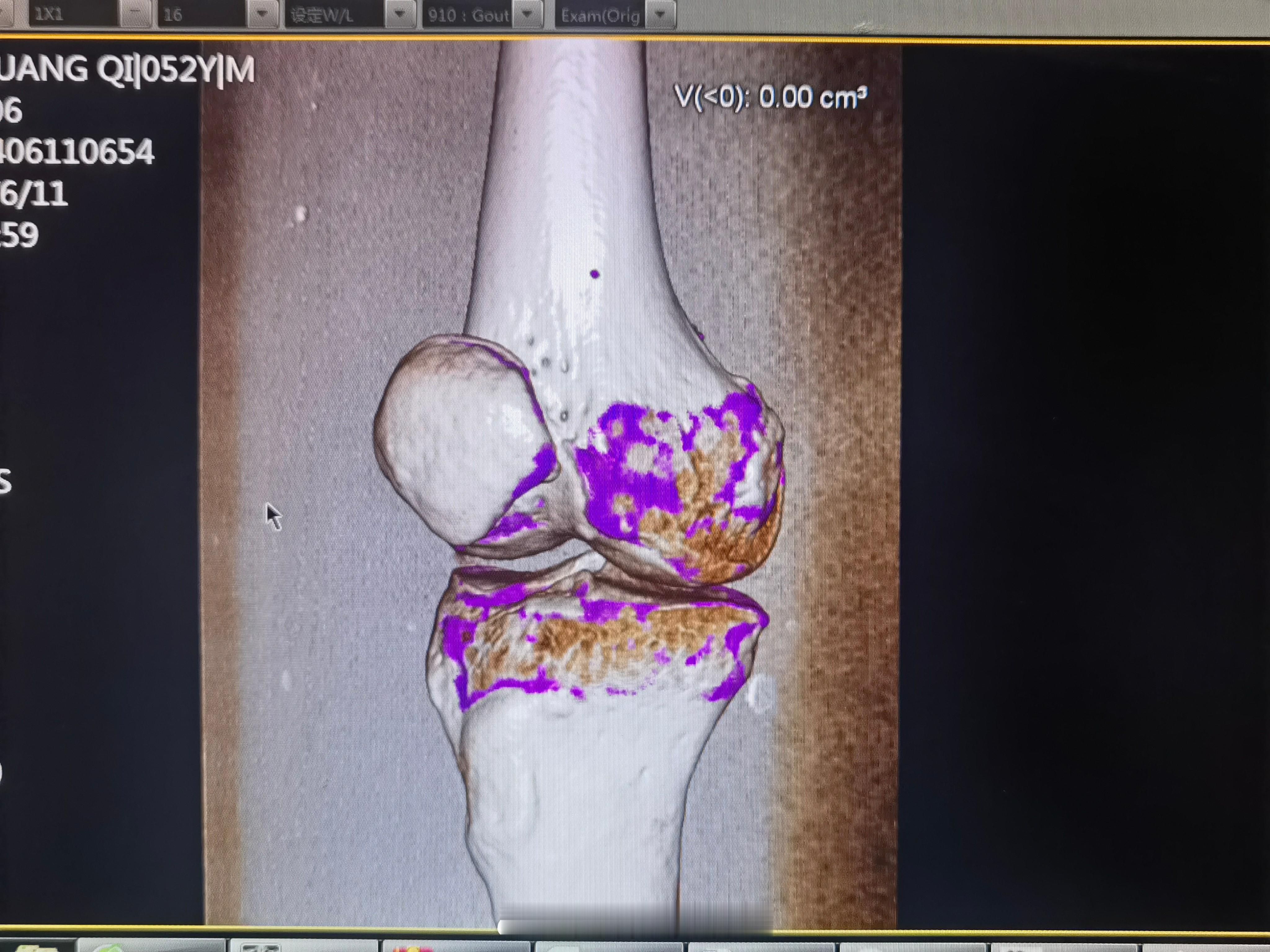 CT怎么会显示紫色？哈哈，惊不惊喜？意不意外？是不是很好看？这叫双源CT，对于不