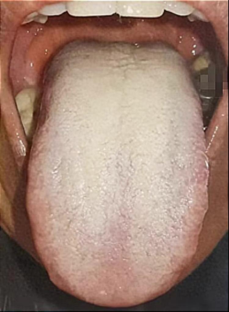 这种白厚腻苔，二陈丸已经无济于事了，用藿香正气才能力挽狂澜
因为二陈丸主要是祛湿