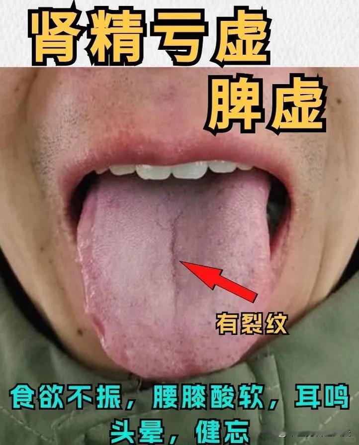 【三种不同体质舌象分析，看看你中了吗？】