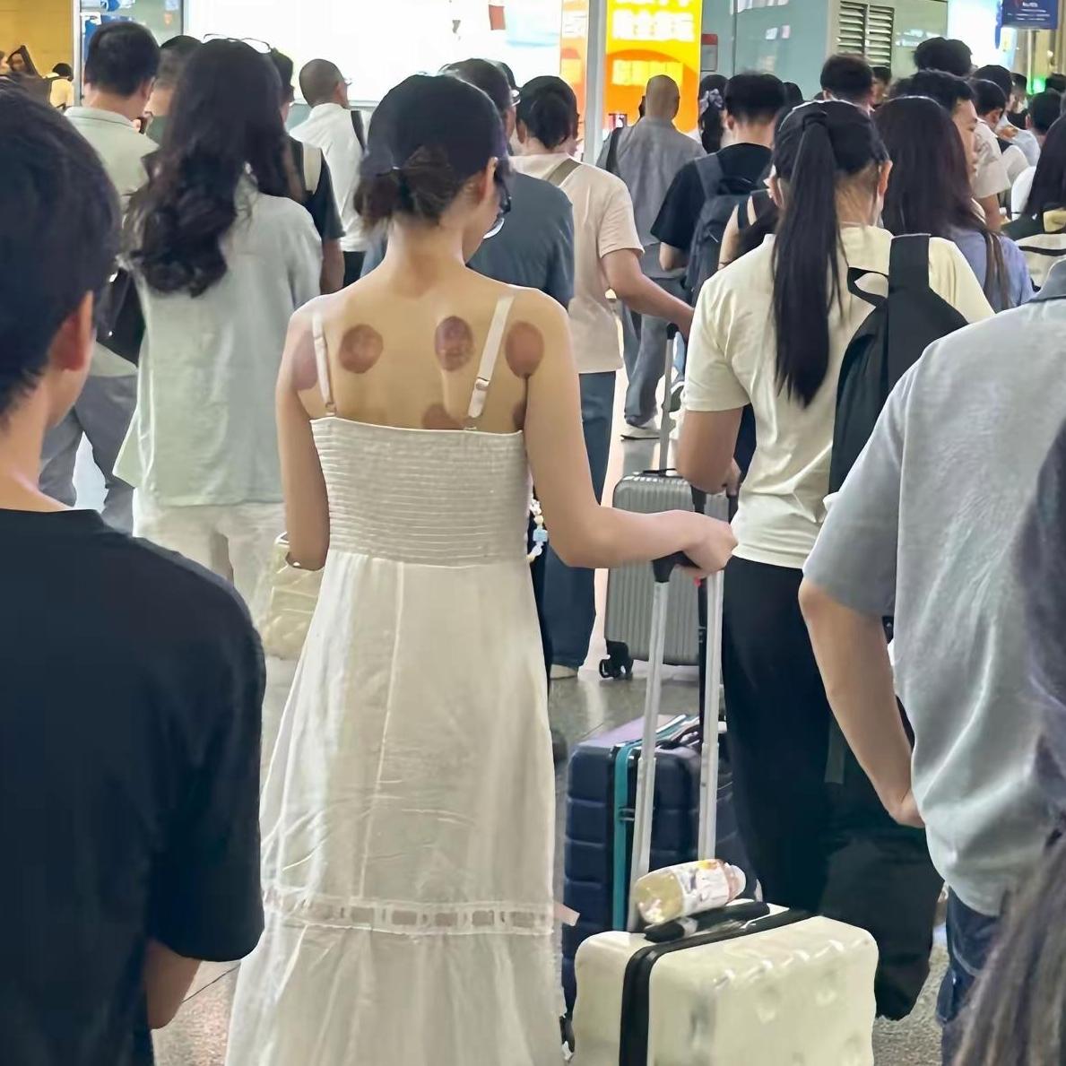 拔完罐出门这么穿，背再多罐子也白搭
 
真有点看不懂，刚拔完罐，后背满是罐印就直