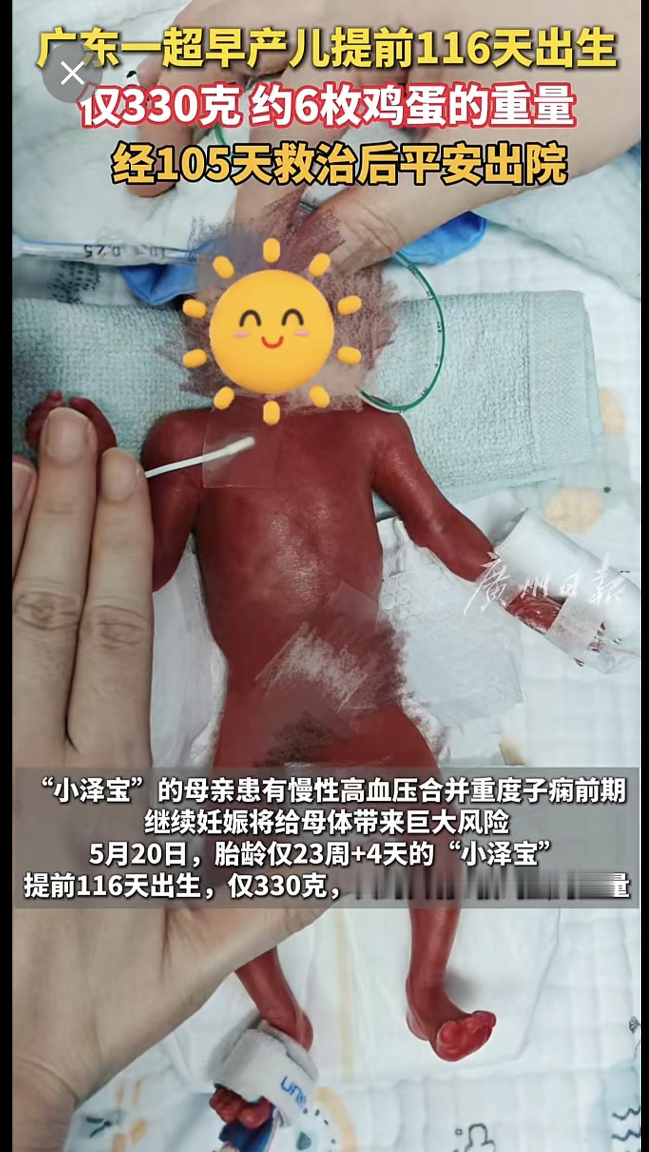 广东一超早产儿提前116天出生，仅330克，约6枚鸡蛋的重量，经105天救治后平