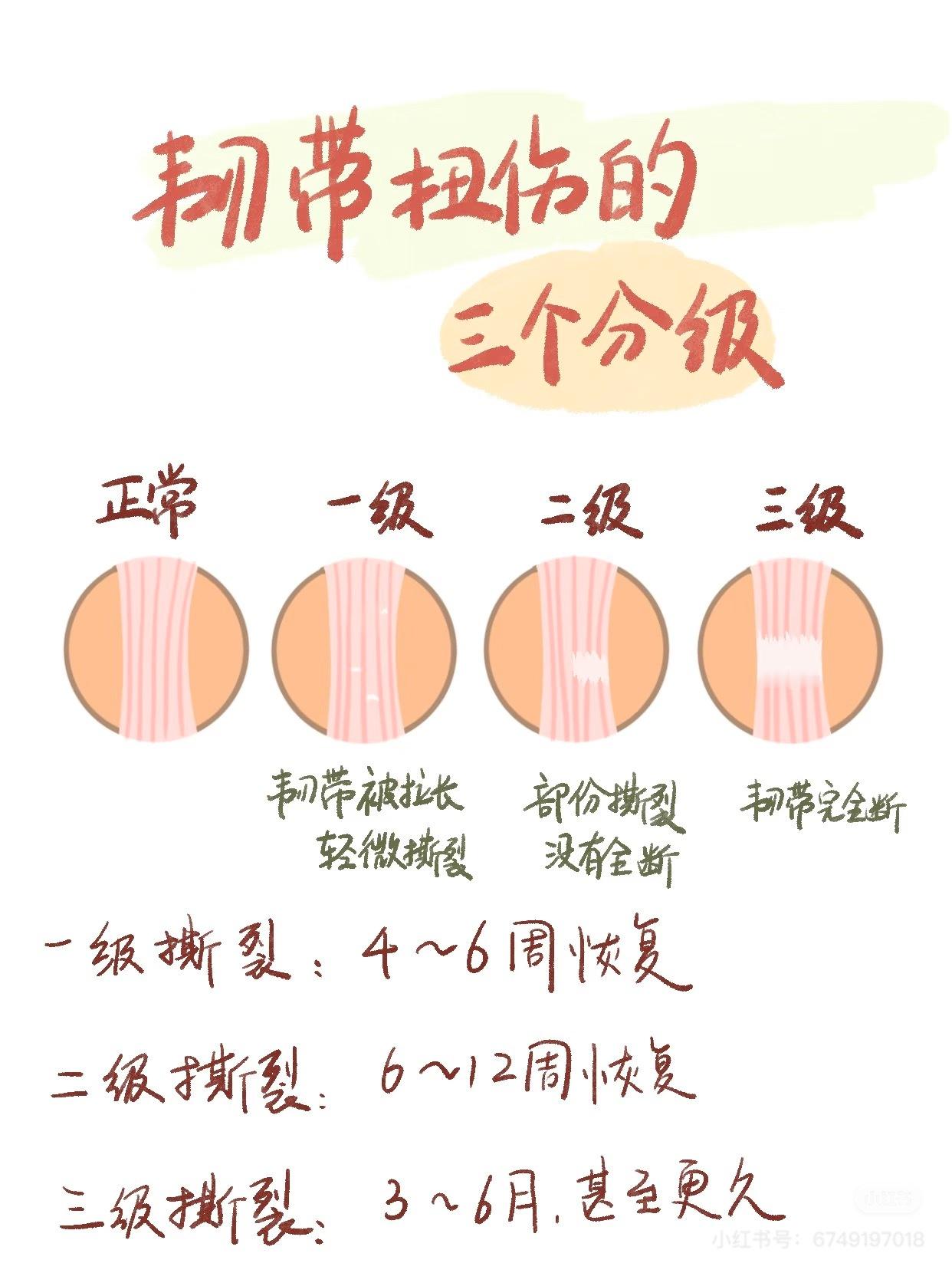 运动康复 【韧带撕裂恢复时间】一张图来带你了解：不同撕裂程度对应的恢复周期👇?