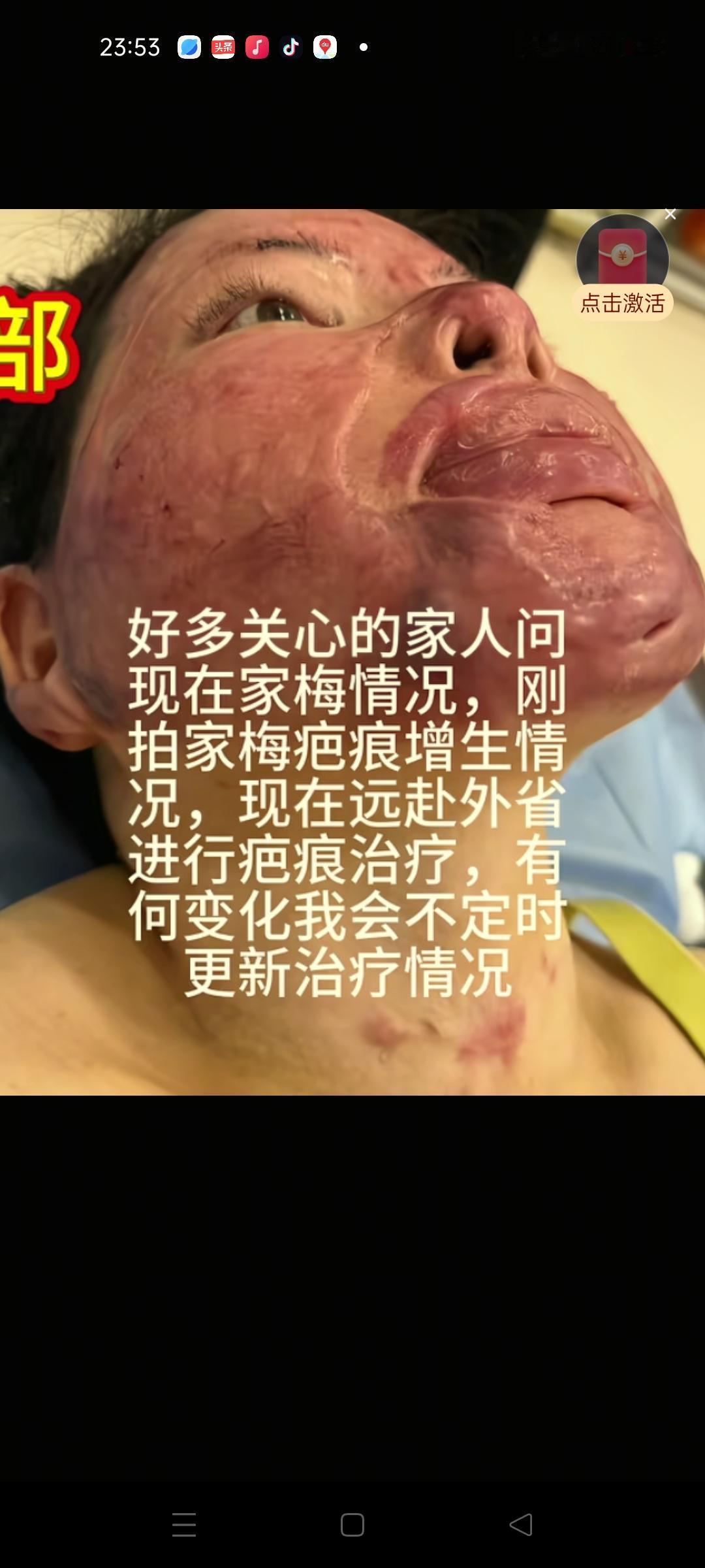 烧伤妈妈一路走来太不容易了，看着她不满增生疤痕的脸，让人不忍直视，痛在她的脸上，