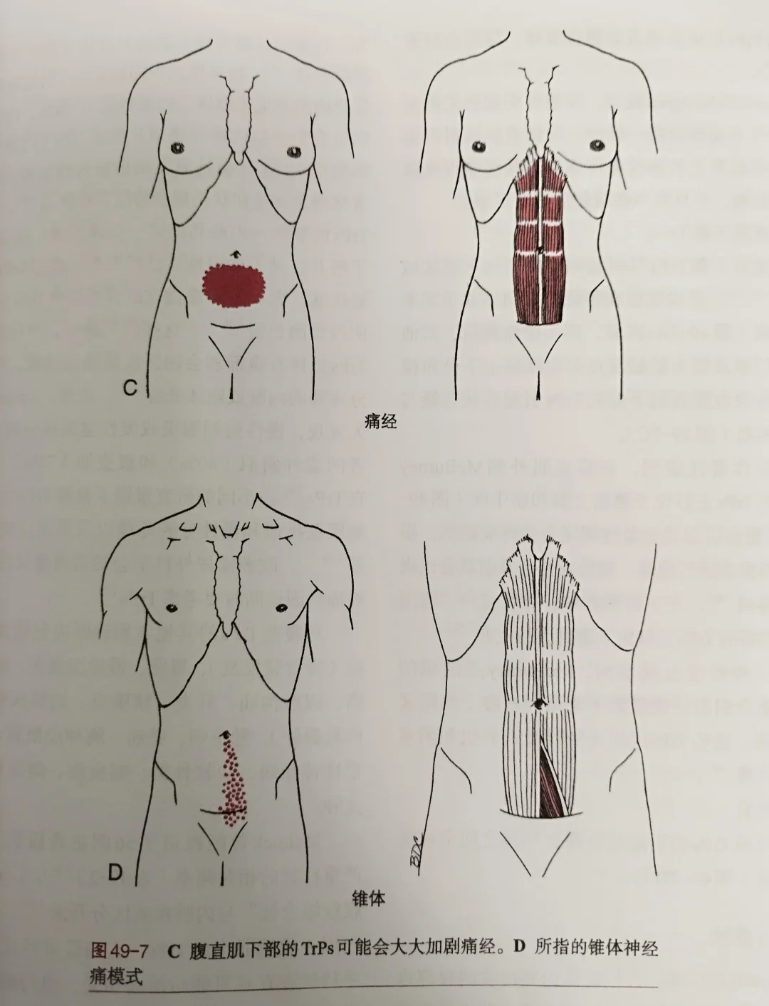 腹直肌下部和锥形肌触发点