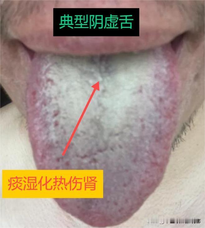 舌头干干巴巴，典型的阴虚舌！用六味地黄缓解容易，要想除根就难了

患者：能力差、