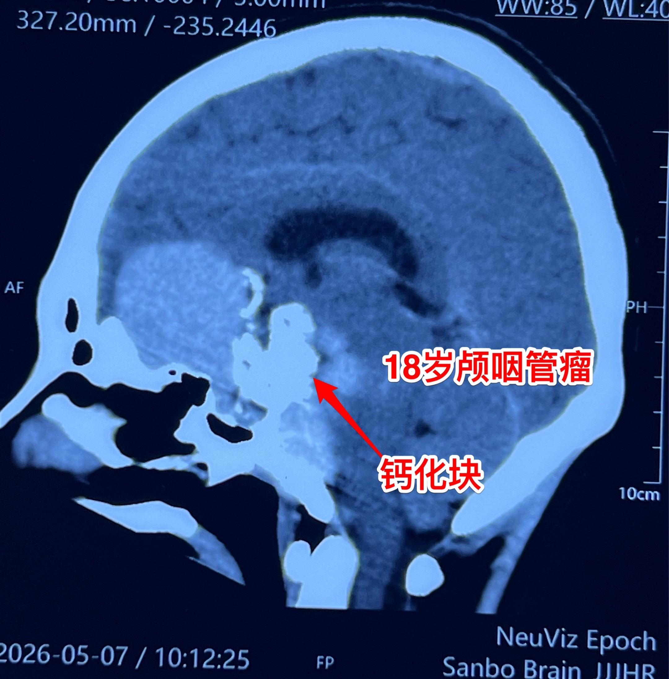 巨大的颅咽管瘤也要尽力作到完全切除！ 我们三博脑科医院颅咽管瘤中心每年...