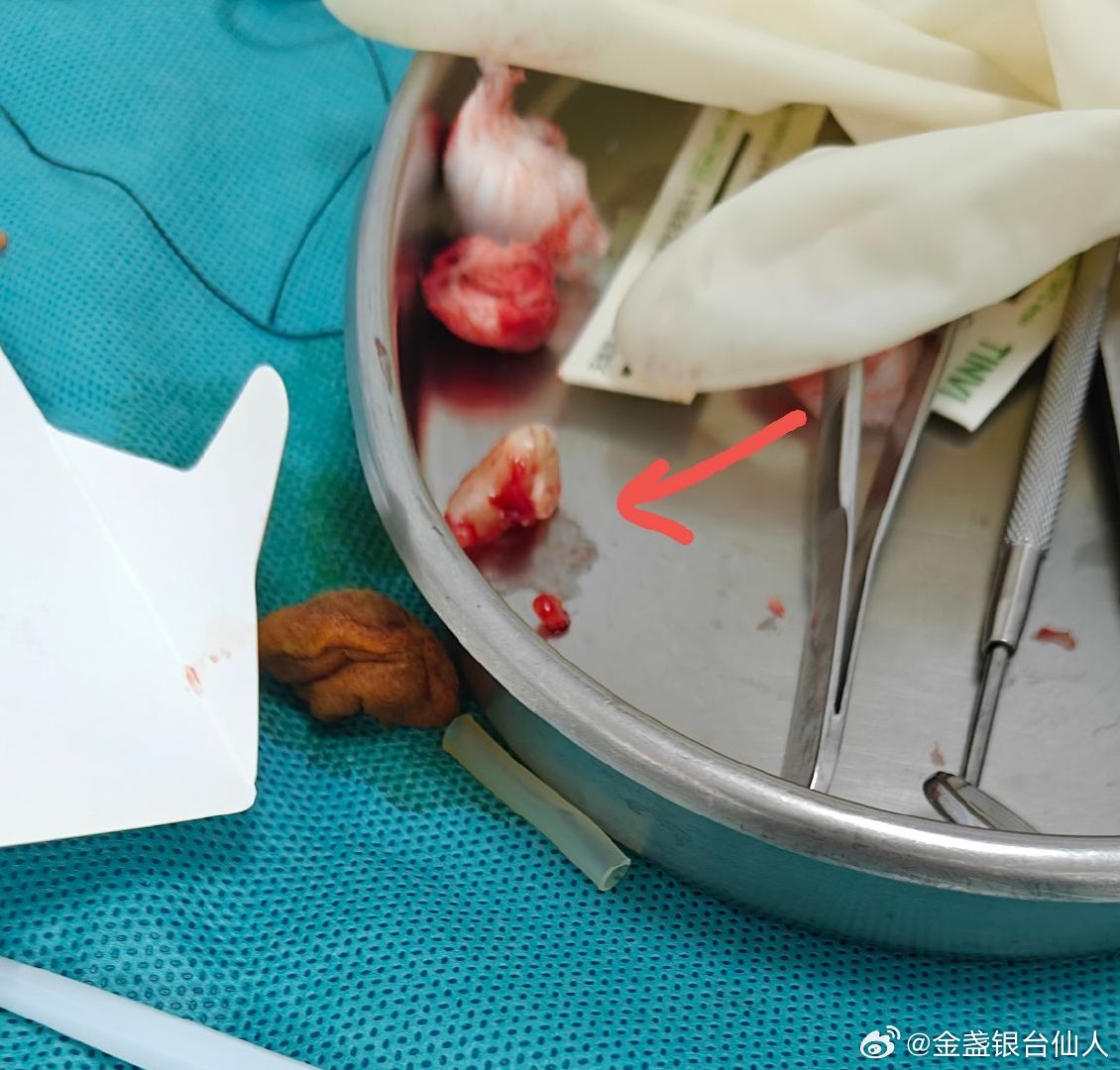 今天去拔了一颗经常发炎的智齿。感觉用具和技术都有进步，医生拿了两根针管来感觉戳了