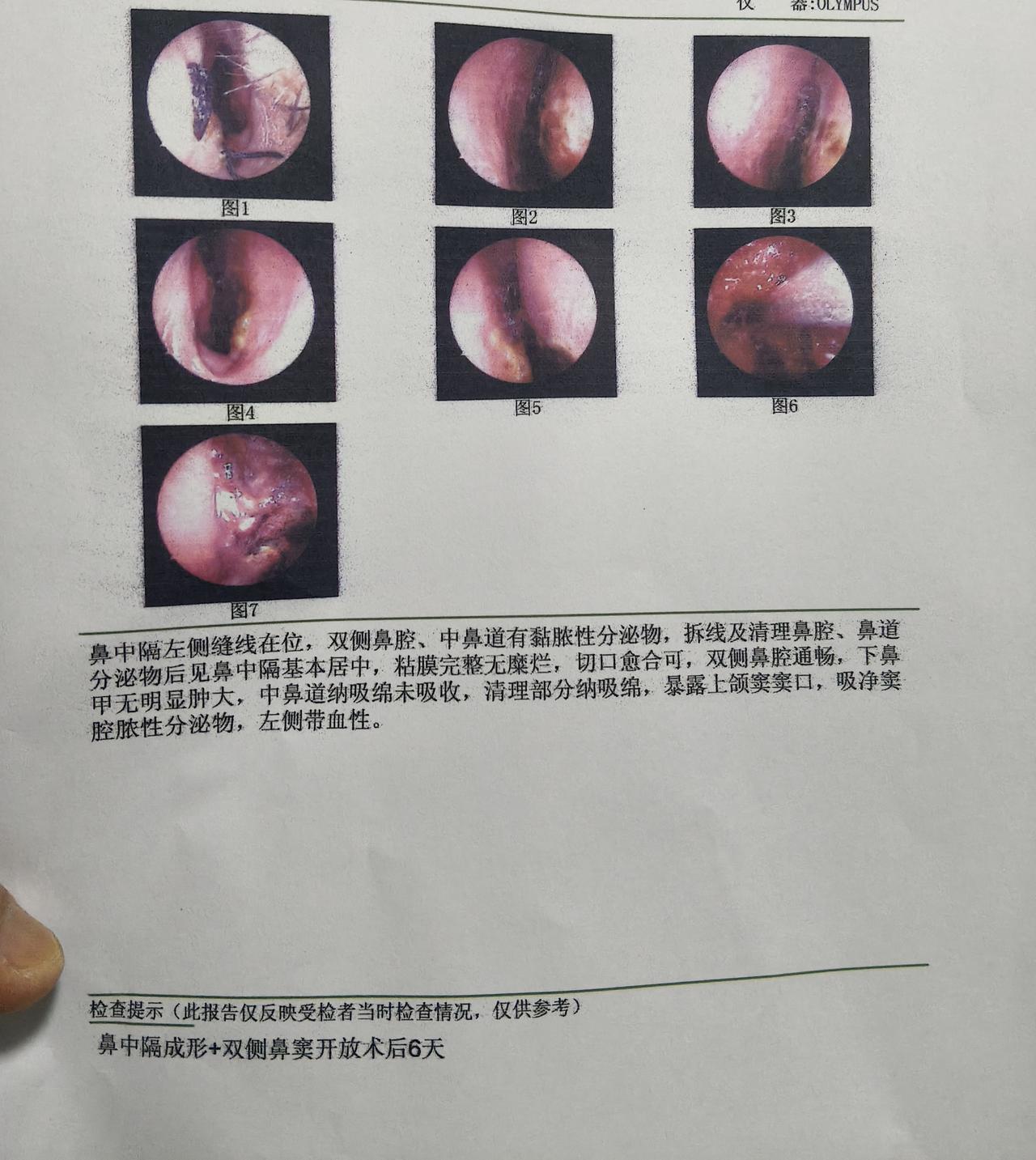 做鼻窦炎、鼻息肉、鼻中隔偏曲手术，最痛苦的是第一次清创！
 
手术后第三天，取了