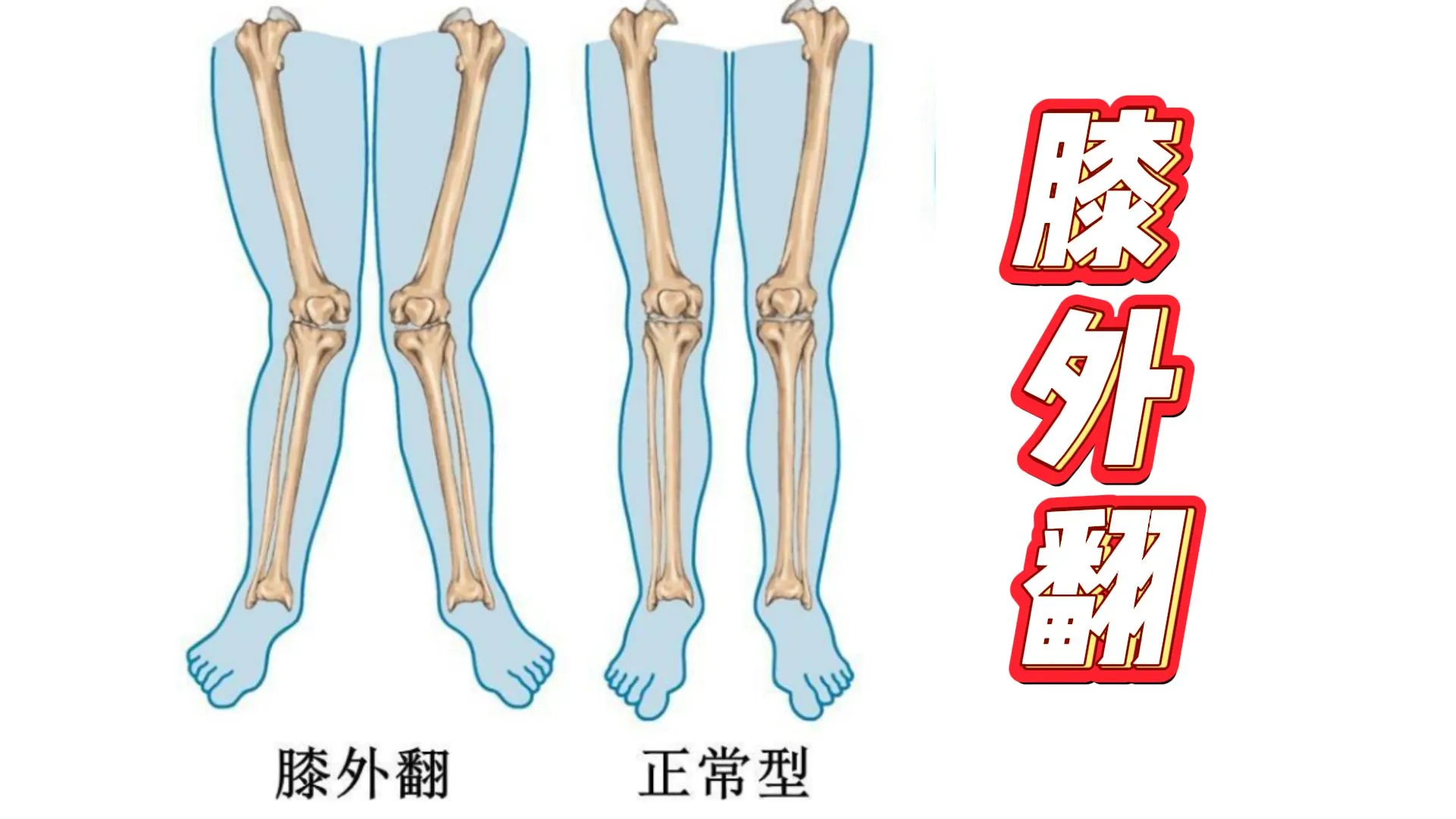 下肢典型的位置型功能障碍