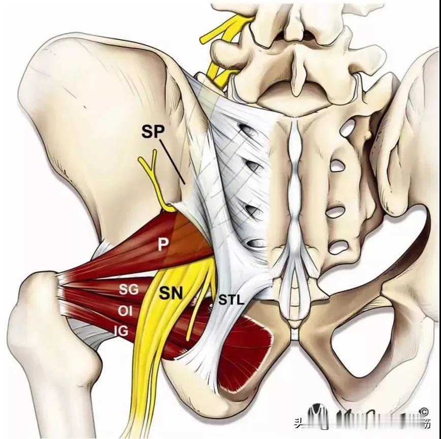 梨状肌综合征：别再误把它当成腰椎间盘突出！