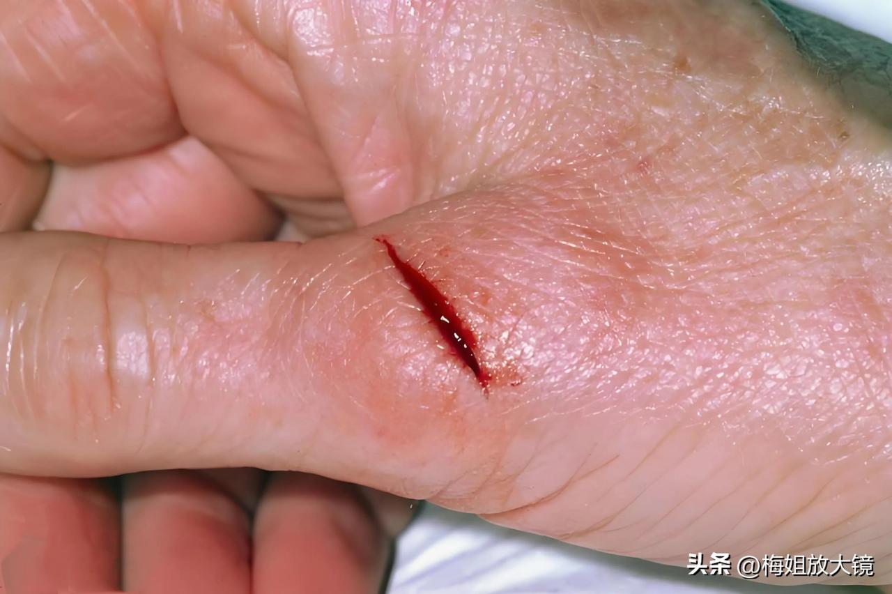 小伤口大危机！郑州梁先生破伤风感染惊险记

近日，河南郑州发生了一起令人警醒的健