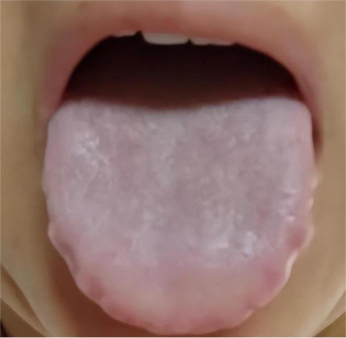 碰到这样的舌头，一点也别拖，直接就用附子、肉桂、干姜、桂枝等补阳的药，阳气才是最