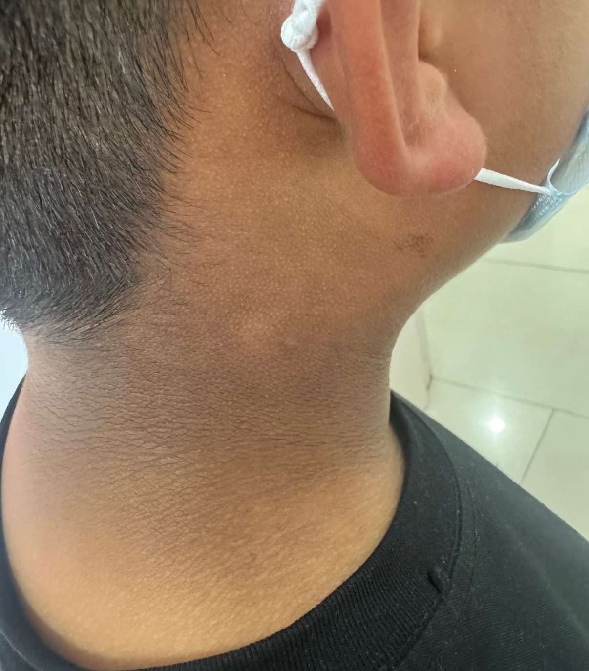 脖子、腋下、大腿根发黑，搓半天也搓不掉？这可能是黑棘皮病——不是单纯皮肤脏，而是