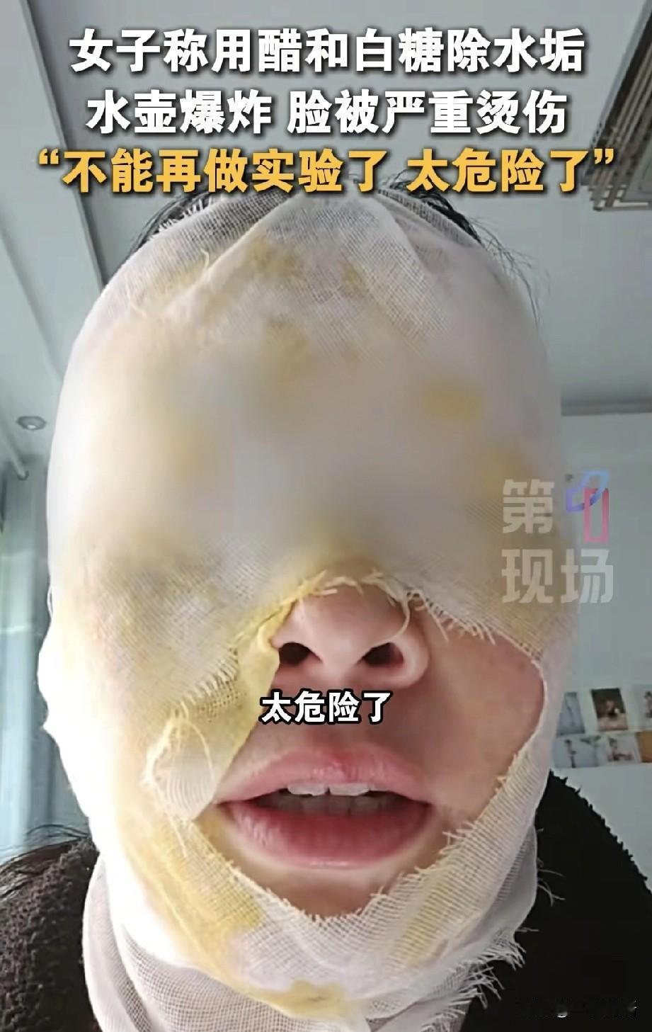 “太吓人了！”10月9日，河北邯郸一女子在家清理保温壶水垢，轻信“网络小妙招”，