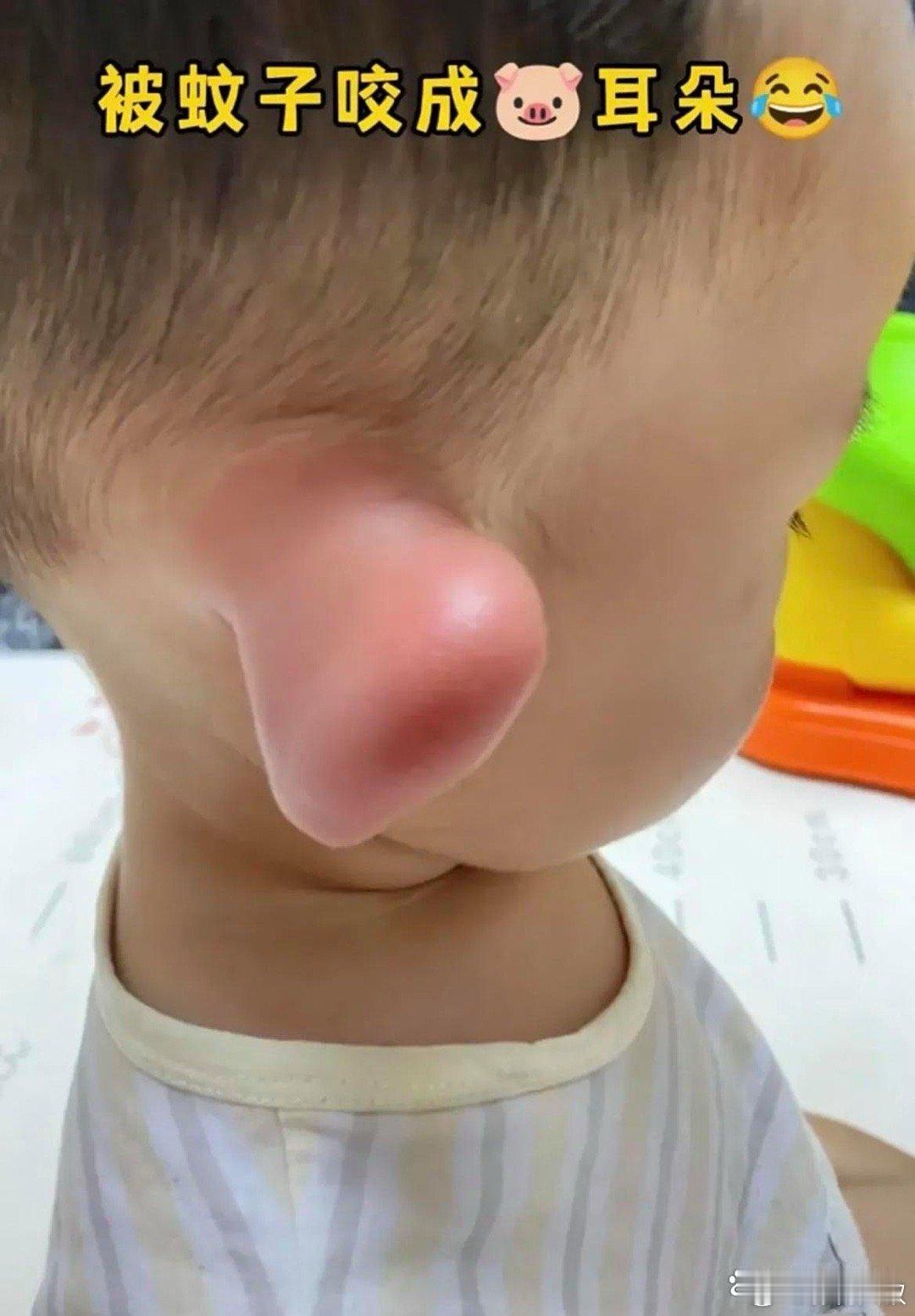 被蚊子咬成猪耳朵了 ​​​