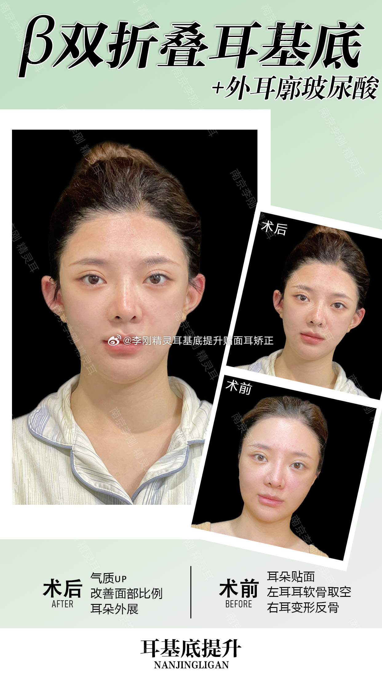 JYP女团成员Angelababy生活手记女团耳朵整形那些事儿