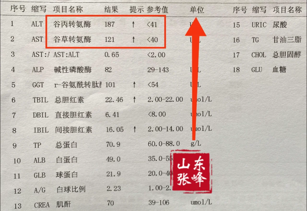 肝功能转氨酶升高一定要重视！ 这是一位山东济南患者的肝功能，有乙肝半年...