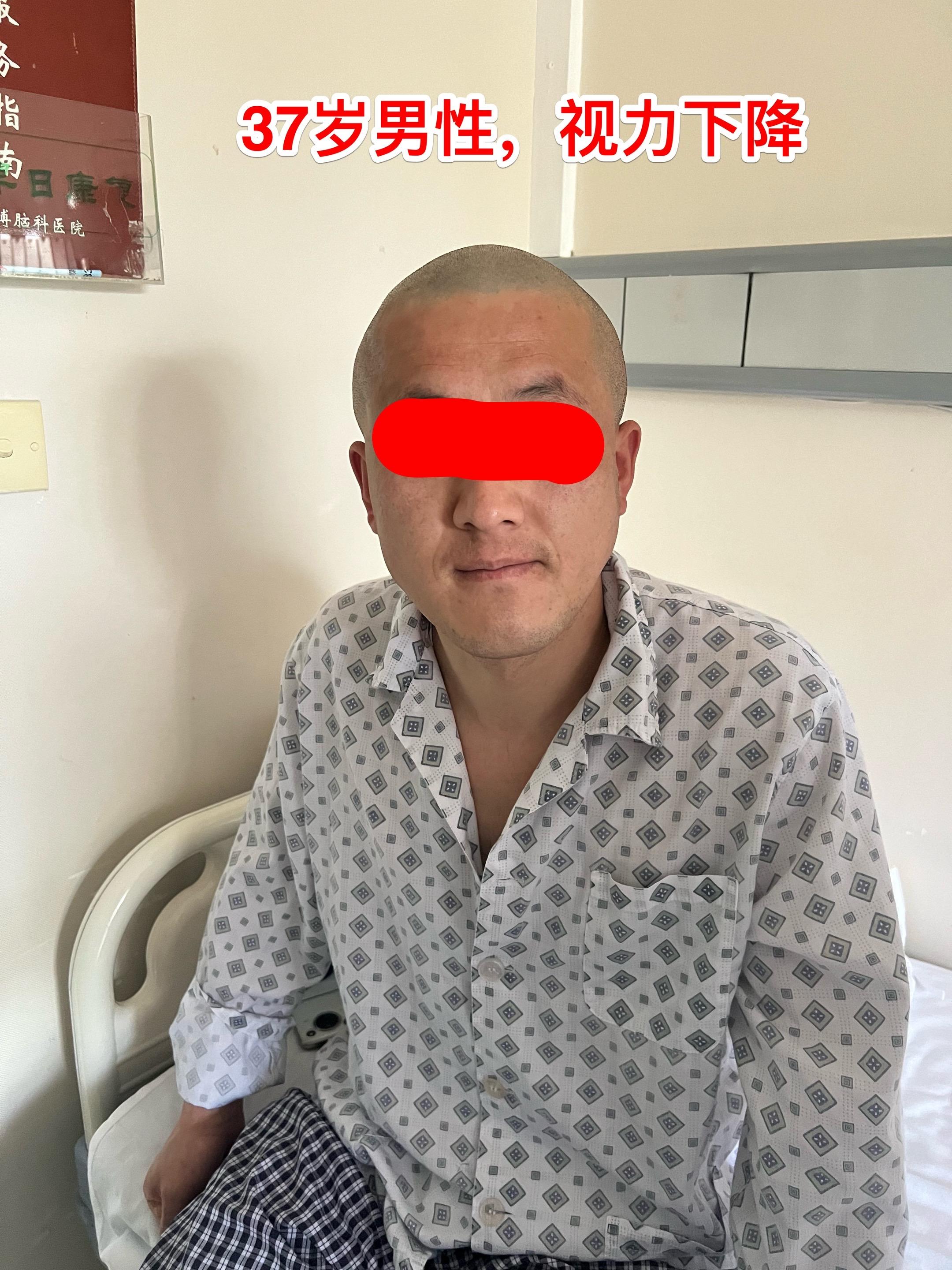 颅咽管瘤合并左侧大脑中动脉狭窄。37岁的承德市男性，因为视力下降到医院...