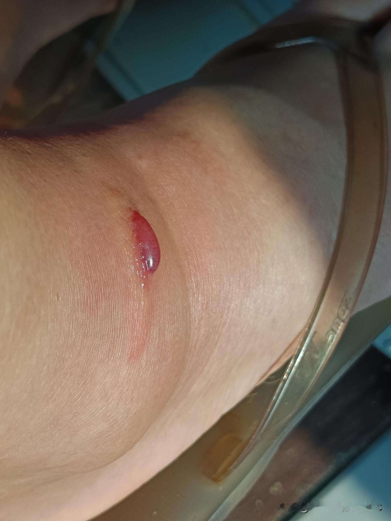 厦门的蚊子也太厉害了吧！昨天发现脚脖子刚开始痒痒，我都没敢用力挠，赶忙涂了药膏，