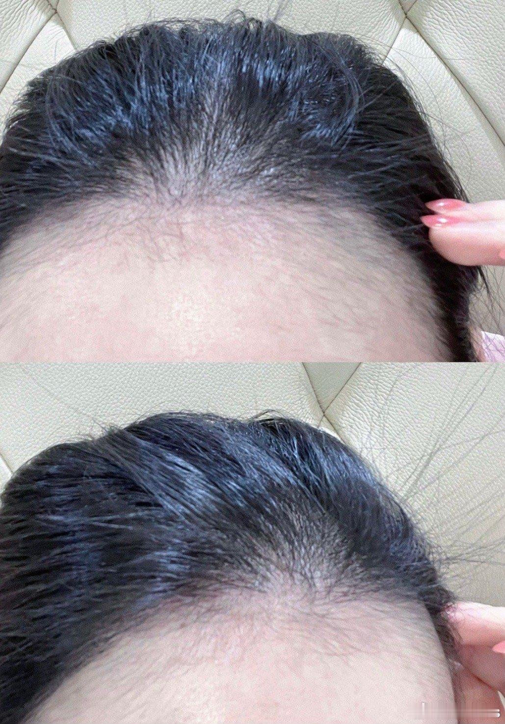 我发现晒太阳是真的能长头发虽然植发过，但我发际线依旧还是挺高的我平时也不晒太阳去