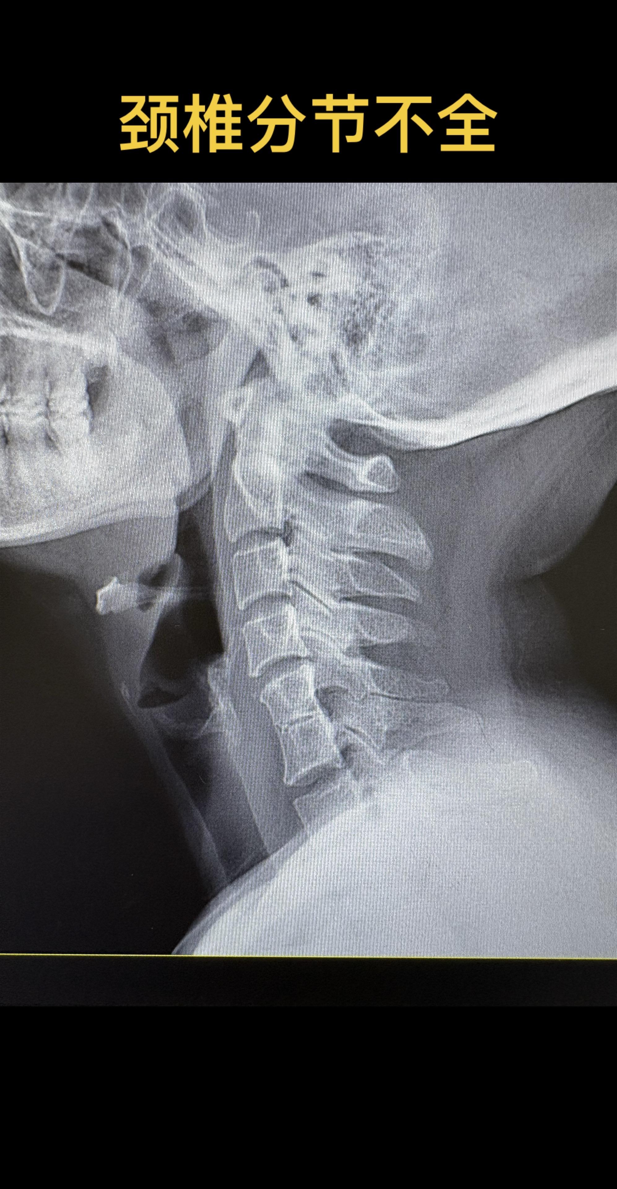 颈56椎体分节不全。一种常见的颈椎发育畸形  klippel-feil综合征