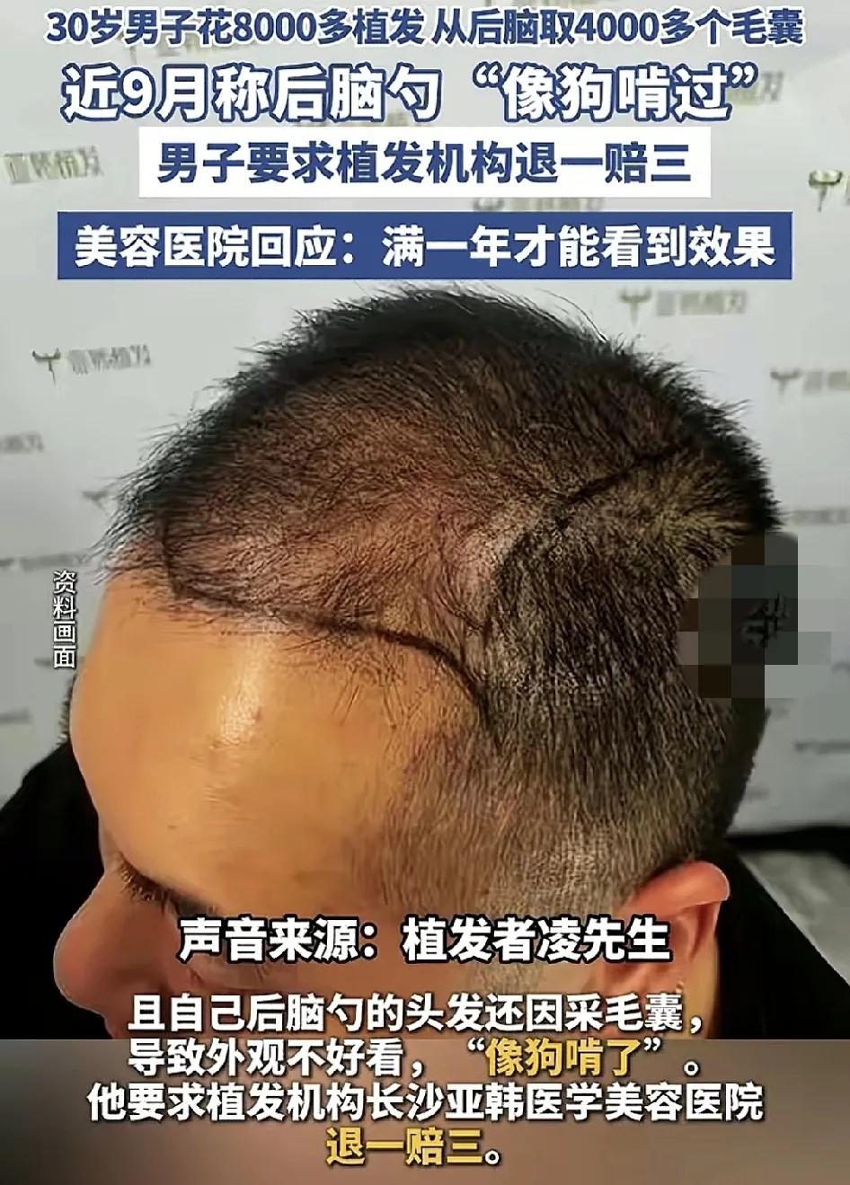 12月6日，长沙一30岁男子反应自己花了8000块钱植发，但是9个月过去，头发跟