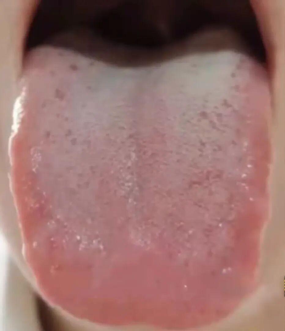 碰到这种舌苔 方向不明确 切记不要乱补
针对患者复杂的病情，若治疗方向不明确，即