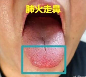 #中医##健康养生# 五脏有火走五官：心火走嘴——用牛黄解毒，肺火走鼻——用清肺