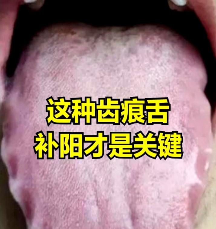 舌边齿痕越治越肿，原来是把火力当水擦。
医生让病人停掉所有祛湿茶，改开桂附地黄汤