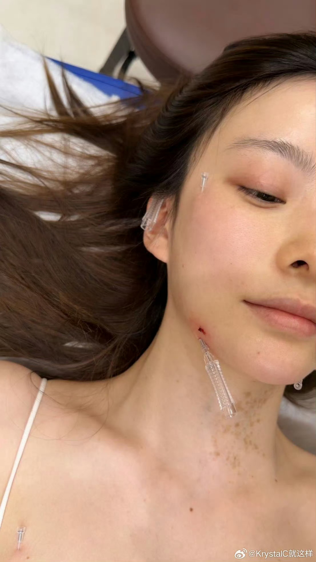 陈卓璇做针灸治疗耳部病情天呐好心疼啊。。看照片里扎满针的样子，真的。歌手耳朵生了
