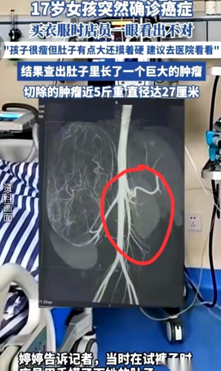 广东一个17岁的女孩，瘦得像根竹竿，体重八十多斤，肚子却像塞了个篮球。
那天，她