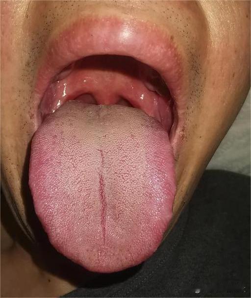 跟你说了多少脾胃的重要性，就是不听，现在湿热这么重了才知道后悔[发怒][发怒]
