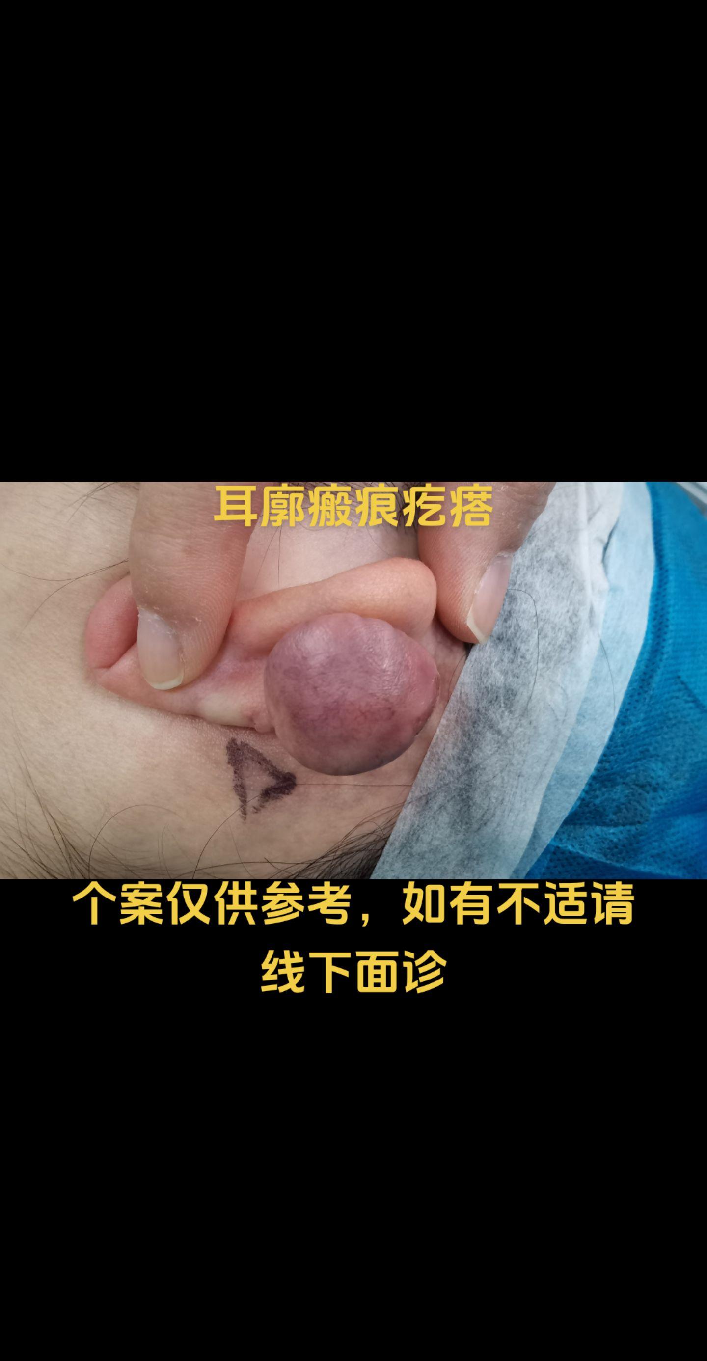 耳部瘢痕疙瘩。耳部瘢痕疙瘩稳定后考虑整形手术治疗，术后规范抗疤治疗，防复发。