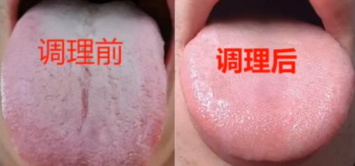 这个舌象猛地一看，舌中裂纹这么深，说明脾肾阴虚，运化肯定好不到哪里去。...