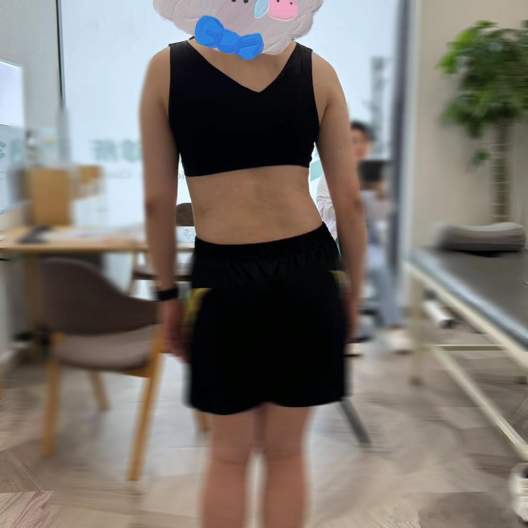 #脊柱侧弯# 前两天北京店初诊了一位腰痛患者，18岁学生。评估师一查，孩子很明显
