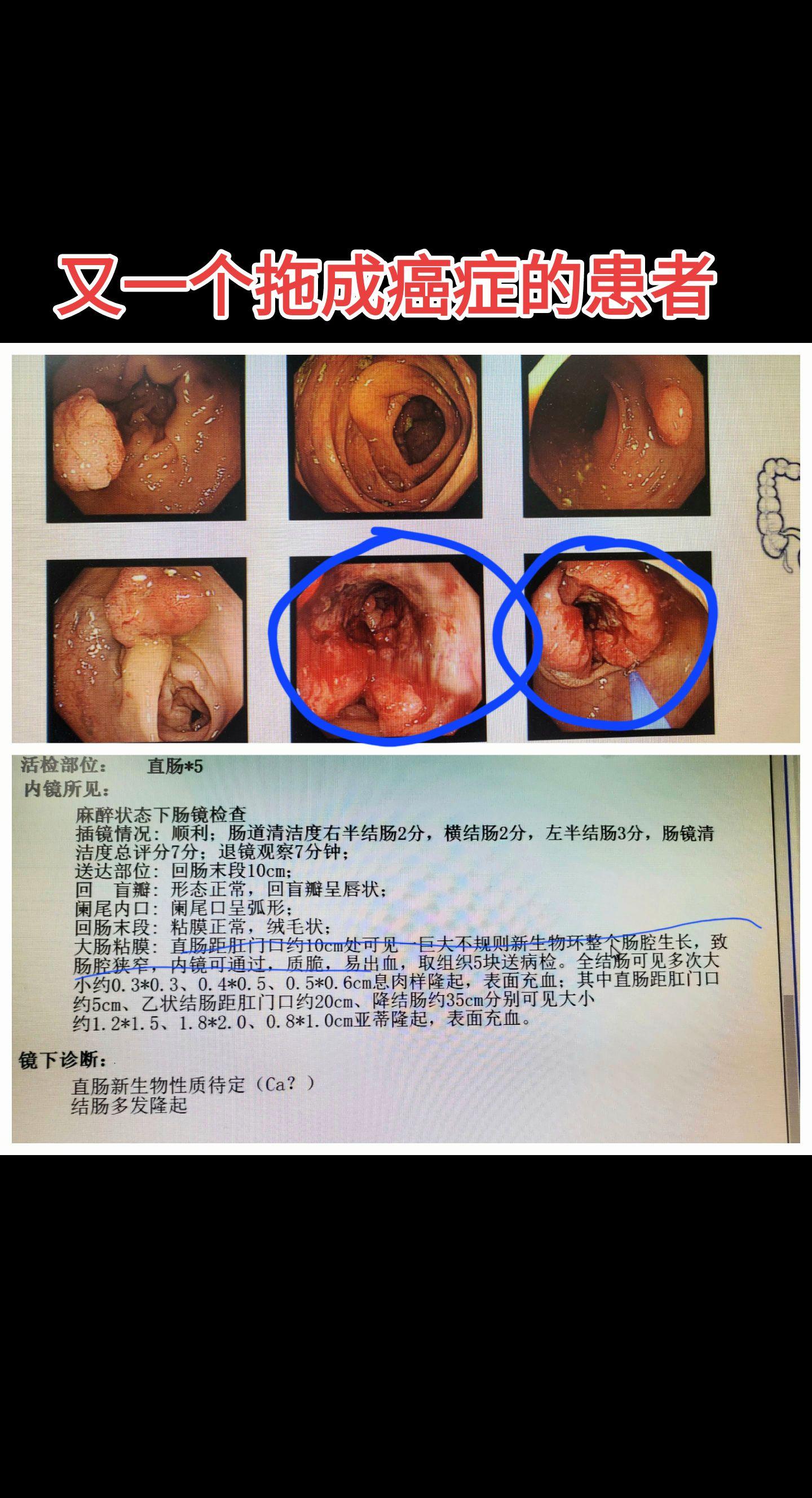 不舒服早点去医院检查，不要为了小钱忍成大病 离肛门比较近，如果手术不能...